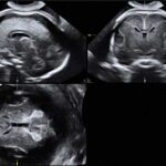 3D74D Ultraschallbild fetales Gehirn