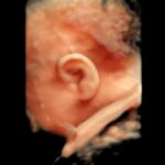 3D Ultraschallbild Ohr pränataldiagnostik