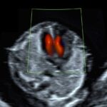 fetale Echokardiographie praenatalschall
